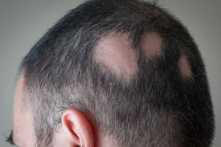 علت ریزش موی سکه‌ای و راه درمان آن