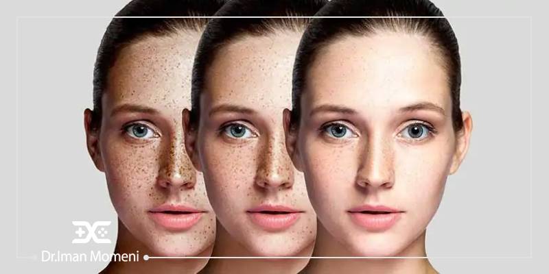 درمان لک صورت - متخصص پوست و مو در اصفهان